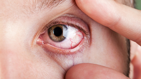 Trockenes Auge